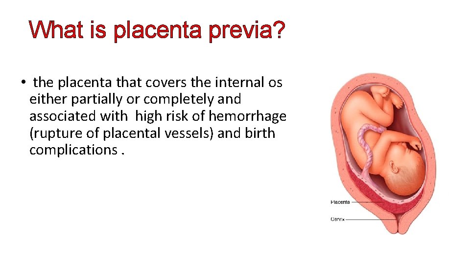 What is placenta previa? • the placenta that covers the internal os either partially