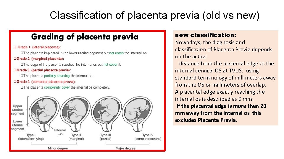 Classification of placenta previa (old vs new) new classification: Nowadays, the diagnosis and classification