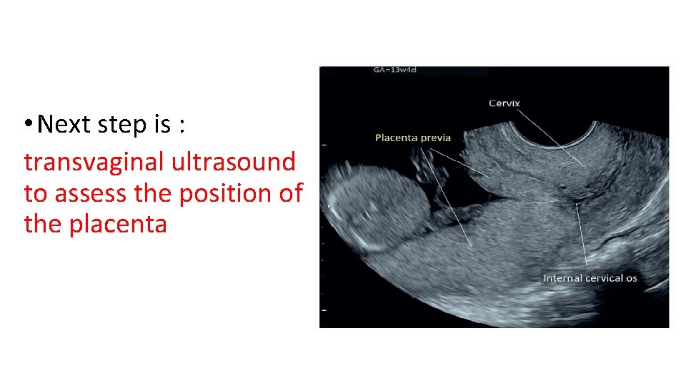  • Next step is : transvaginal ultrasound to assess the position of the