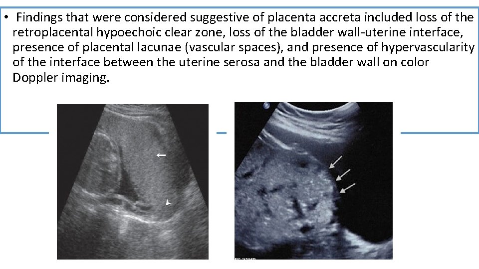  • Findings that were considered suggestive of placenta accreta included loss of the