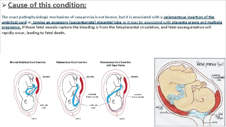 Ø Cause of this condition: The exact pathophysiologic mechanism of vasa previa is not