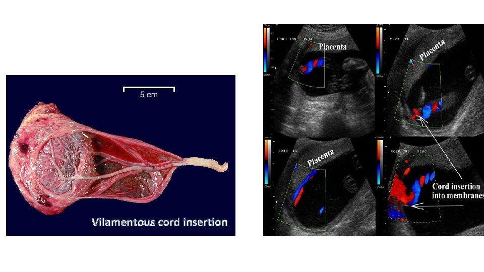 Vilamentous cord insertion 