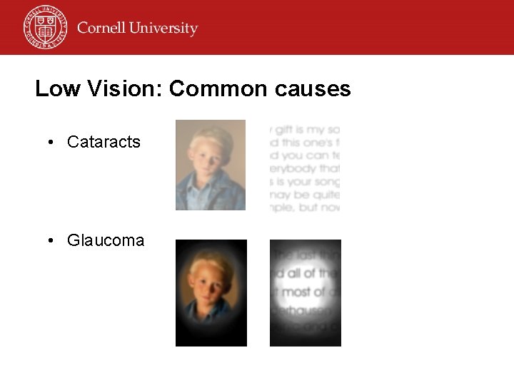 Low Vision: Common causes • Cataracts • Glaucoma 