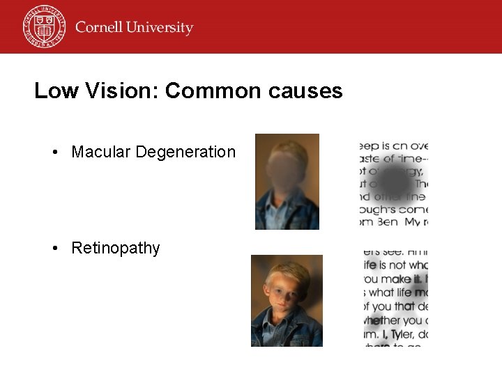 Low Vision: Common causes • Macular Degeneration • Retinopathy 