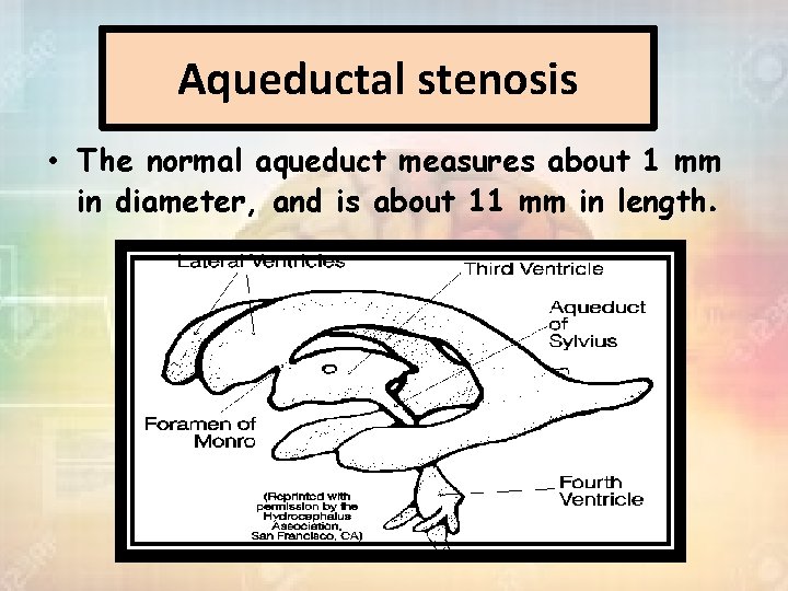 Aqueductal stenosis • The normal aqueduct measures about 1 mm in diameter, and is