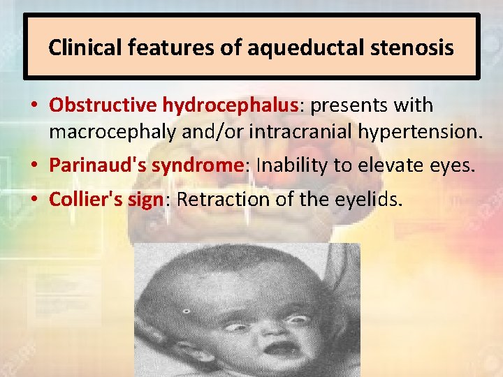 Clinical features of aqueductal stenosis • Obstructive hydrocephalus: presents with macrocephaly and/or intracranial hypertension.