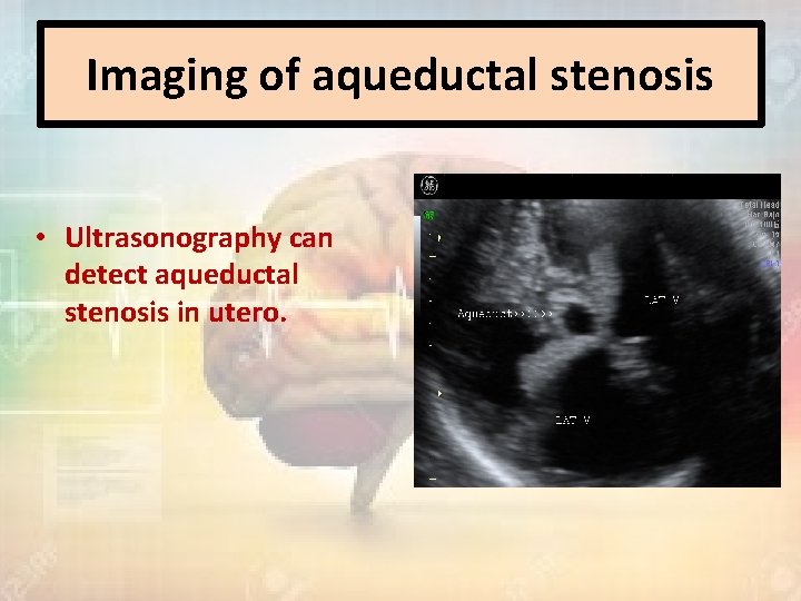 Imaging of aqueductal stenosis • Ultrasonography can detect aqueductal stenosis in utero. 