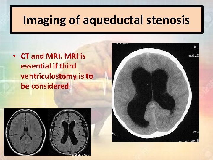 Imaging of aqueductal stenosis • CT and MRI is essential if third ventriculostomy is