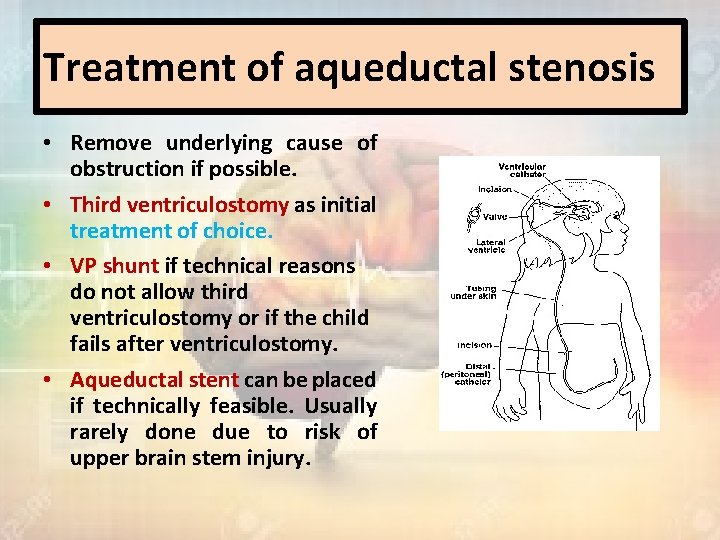 Treatment of aqueductal stenosis • Remove underlying cause of obstruction if possible. • Third