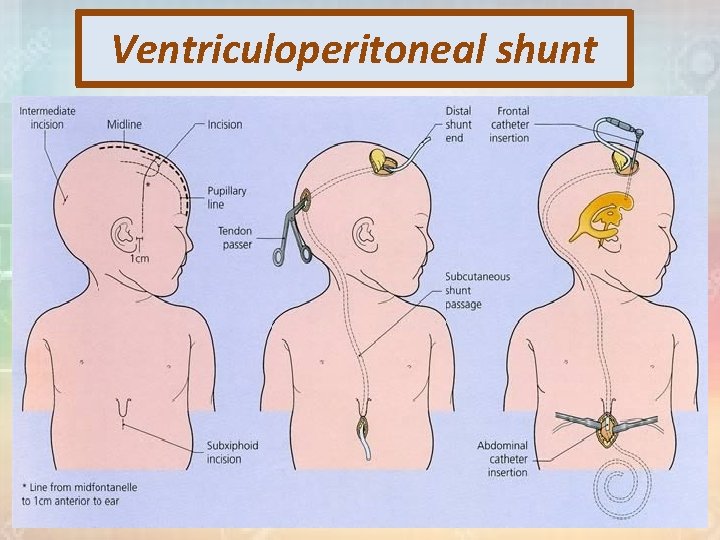 Ventriculoperitoneal shunt 