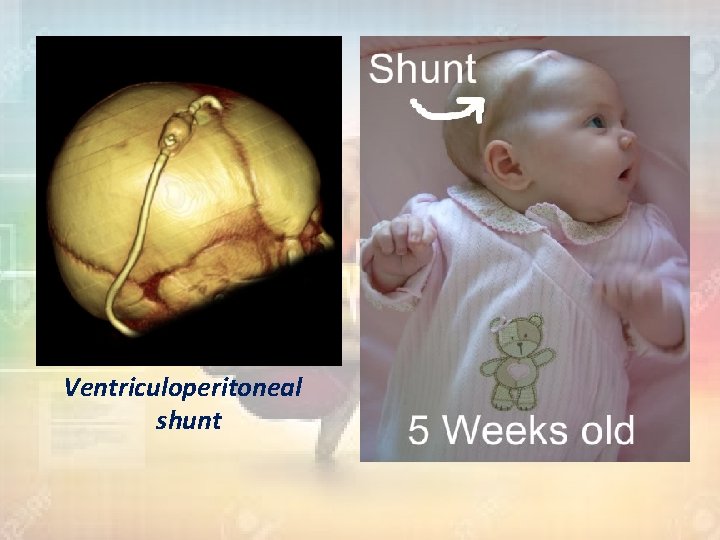 Ventriculoperitoneal shunt 
