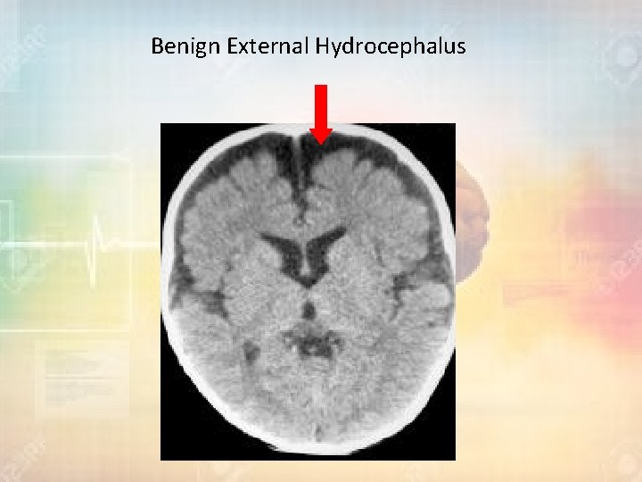 Benign External Hydrocephalus 
