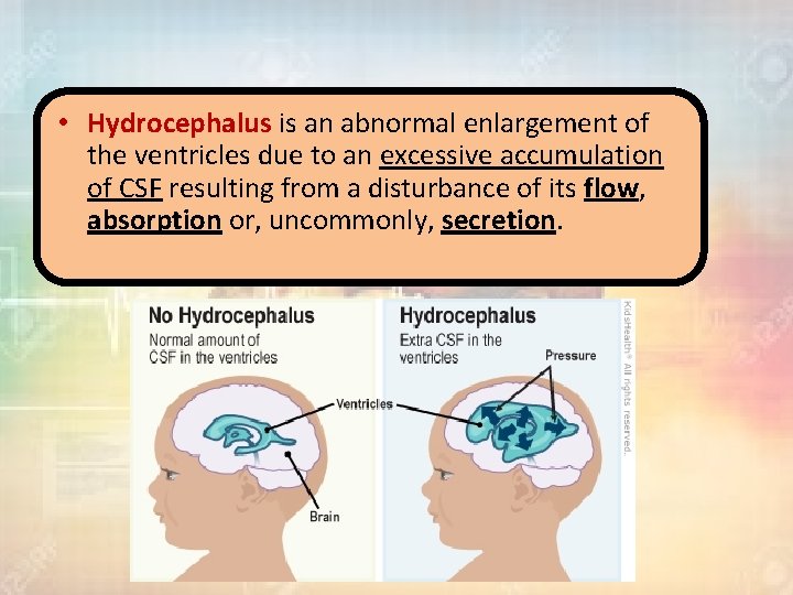  • Hydrocephalus is an abnormal enlargement of the ventricles due to an excessive