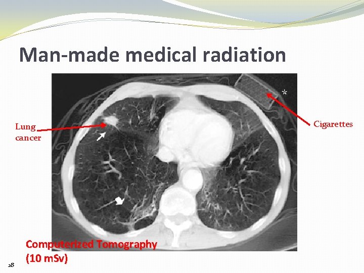 Man-made medical radiation Lung cancer 28 Computerized Tomography (10 m. Sv) Cigarettes 