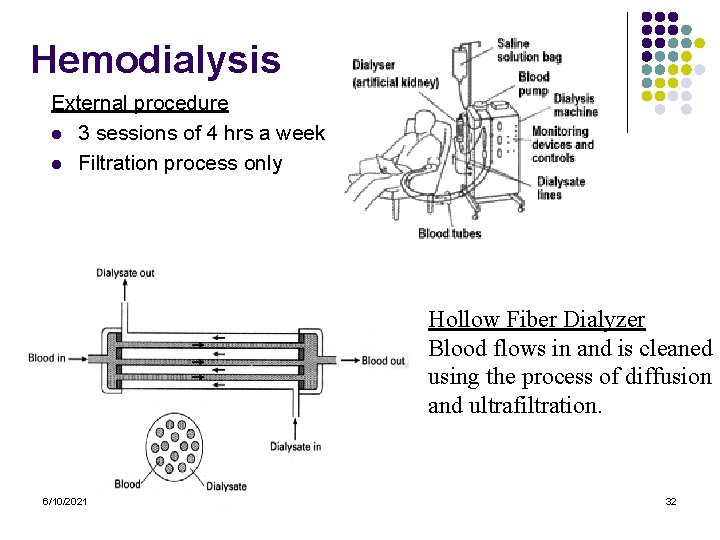 Hemodialysis External procedure l 3 sessions of 4 hrs a week l Filtration process