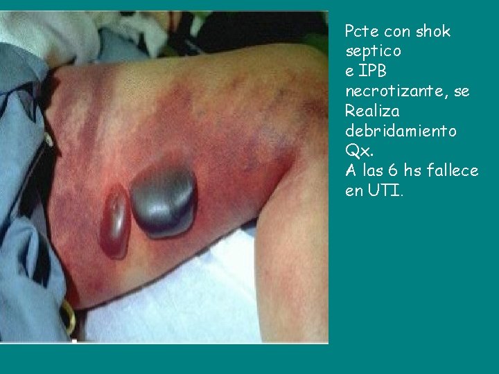 Pcte con shok septico e IPB necrotizante, se Realiza debridamiento Qx. A las 6