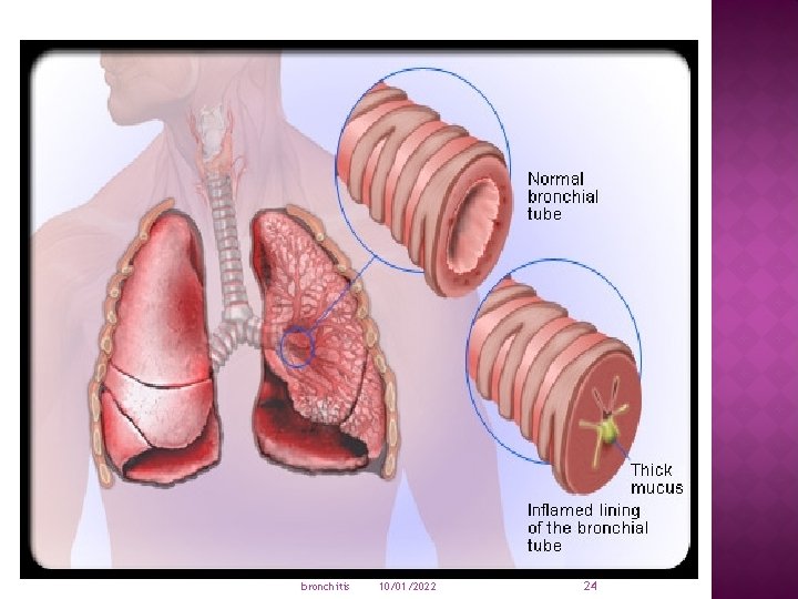 bronchitis 10/01/2022 24 