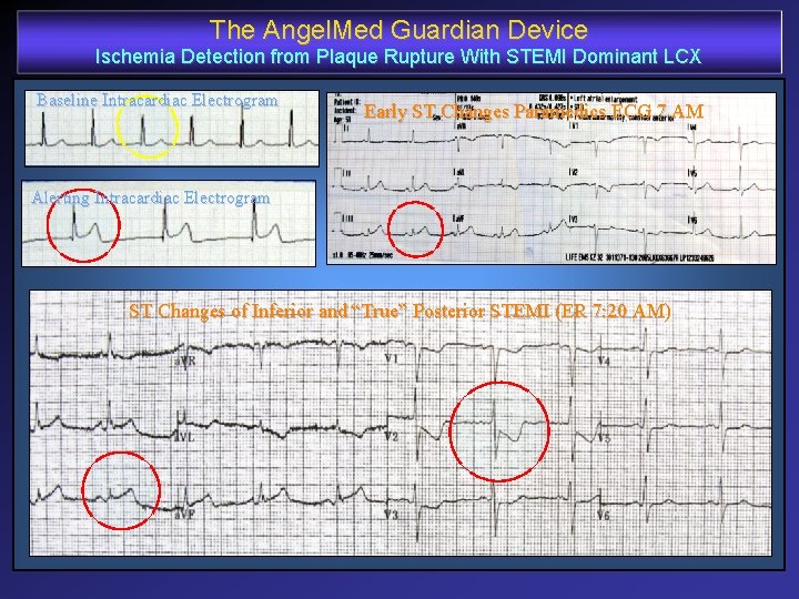 The Angel. Med Guardian Device Ischemia Detection from Plaque Rupture With STEMI Dominant LCX