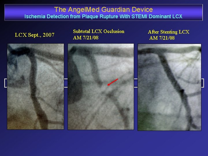 The Angel. Med Guardian Device Ischemia Detection from Plaque Rupture With STEMI Dominant LCX