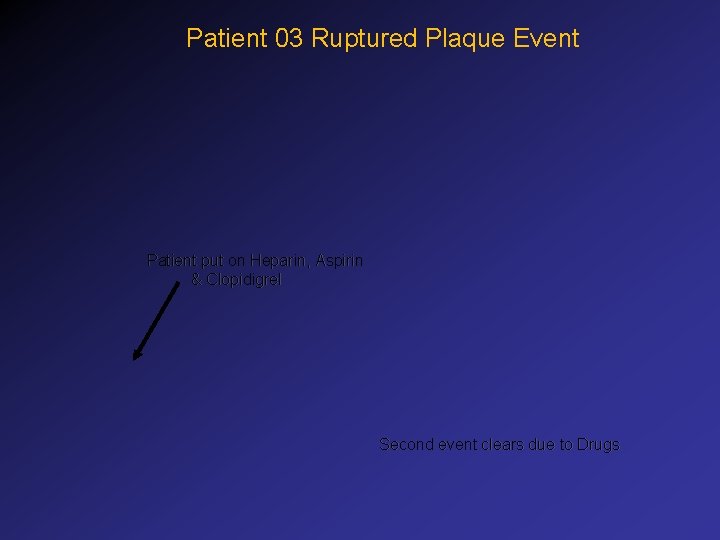 Patient 03 Ruptured Plaque Event Patient put on Heparin, Aspirin & Clopidigrel Second event