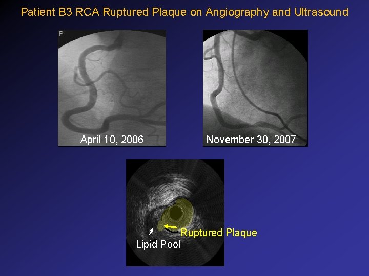 Patient B 3 RCA Ruptured Plaque on Angiography and Ultrasound April 10, 2006 November