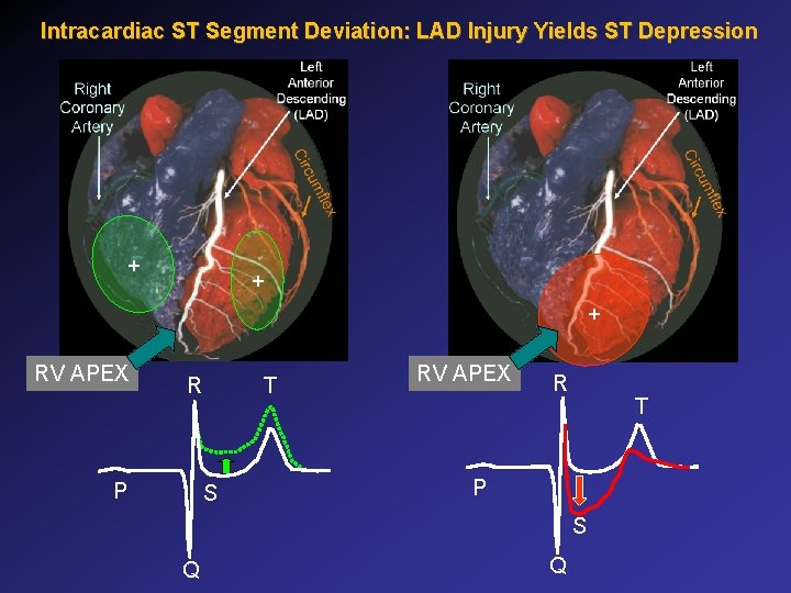 Intracardiac ST Segment Deviation: LAD Injury Yields ST Depression + + + RV APEX