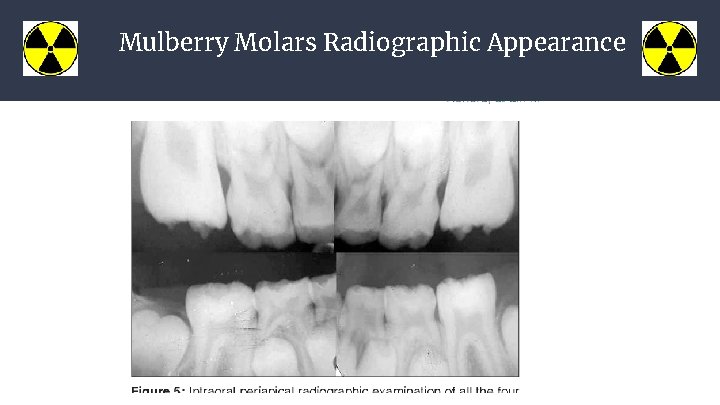Mulberry Molars Radiographic Appearance 