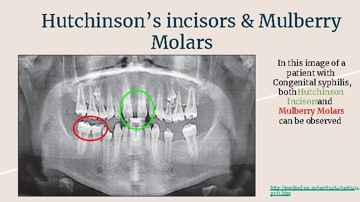 Hutchinson’s incisors & Mulberry Molars In this image of a patient with Congenital syphilis,