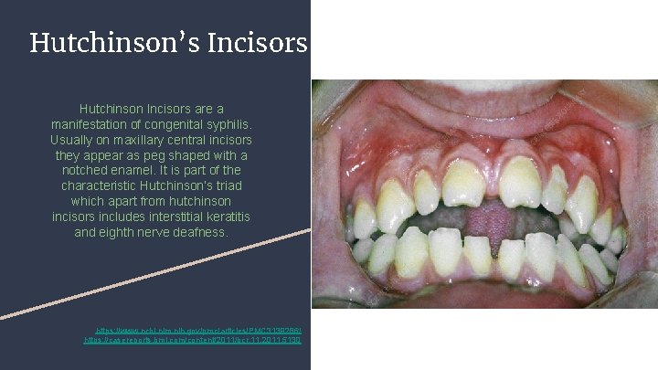 Hutchinson’s Incisors Hutchinson Incisors are a manifestation of congenital syphilis. Usually on maxillary central