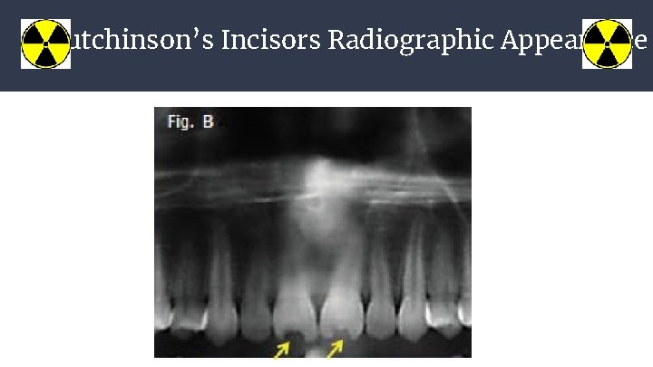 Hutchinson’s Incisors Radiographic Appearance 