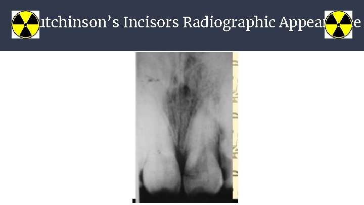 Hutchinson’s Incisors Radiographic Appearance 