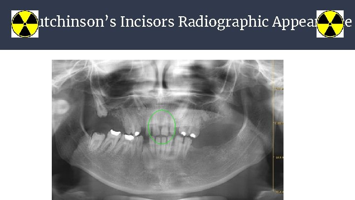 Hutchinson’s Incisors Radiographic Appearance 