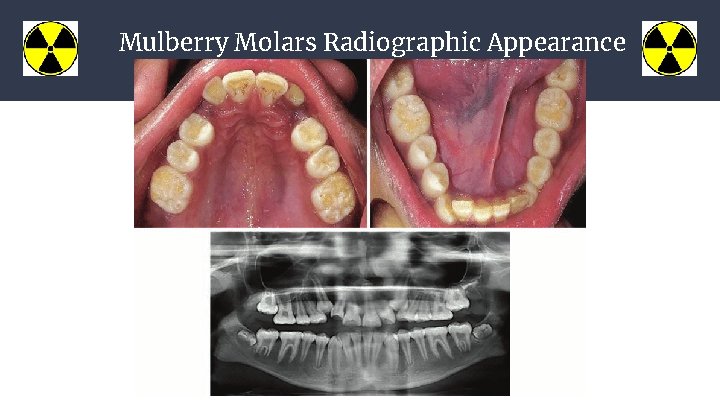 Mulberry Molars Radiographic Appearance 