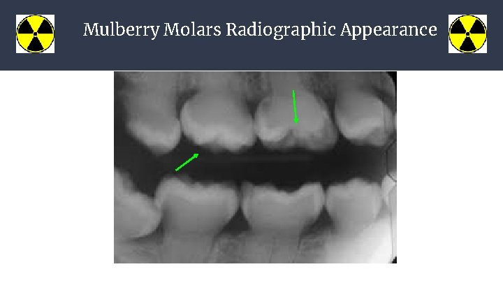 Mulberry Molars Radiographic Appearance 