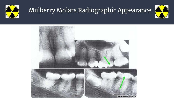 Mulberry Molars Radiographic Appearance 