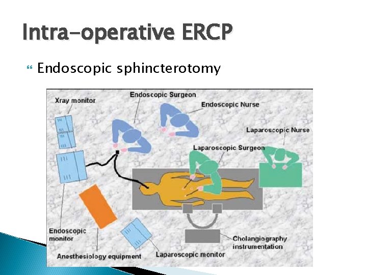 Intra-operative ERCP Endoscopic sphincterotomy 