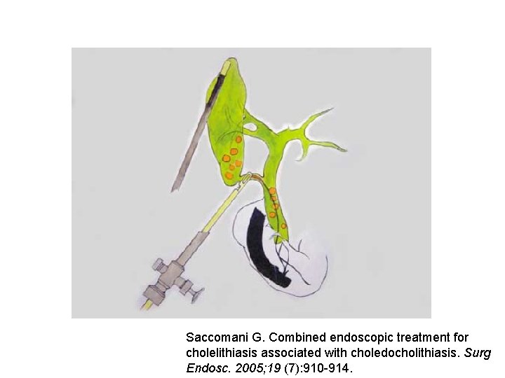 Saccomani G. Combined endoscopic treatment for cholelithiasis associated with choledocholithiasis. Surg Endosc. 2005; 19