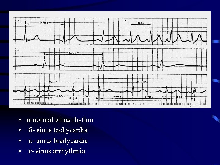  • • a-normal sinus rhythm б- sinus tachycardia в- sinus bradycardia г- sinus