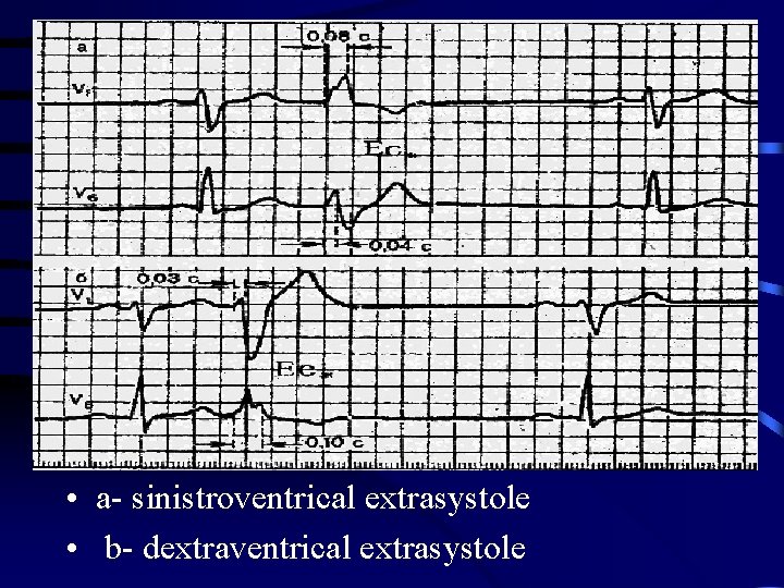  • a- sinistroventrical extrasystole • b- dextraventrical extrasystole 