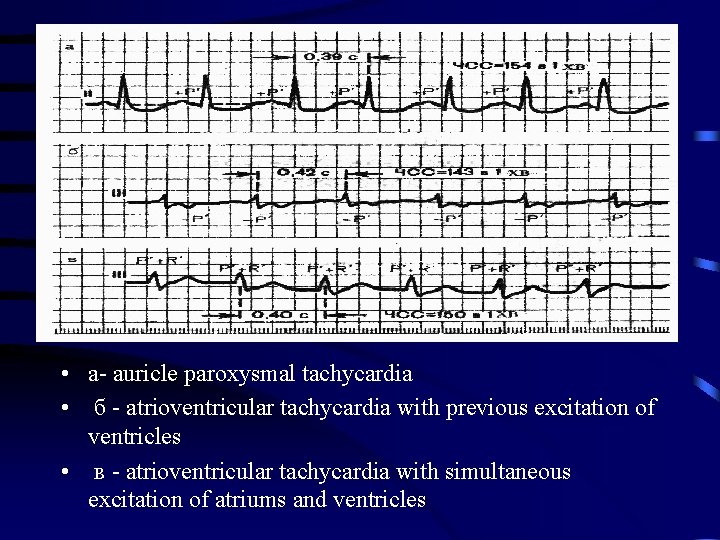  • a- auricle paroxysmal tachycardia • б - atrioventricular tachycardia with previous excitation