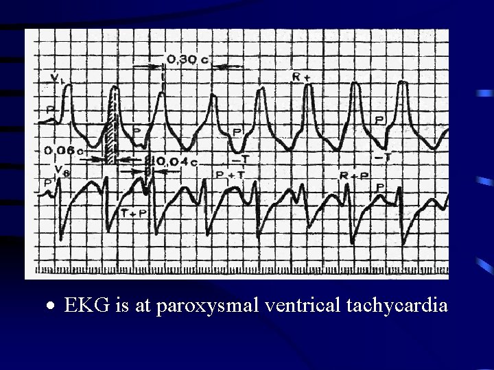 · EKG is at paroxysmal ventrical tachycardia 