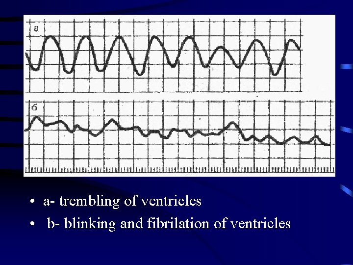  • a- trembling of ventricles • b- blinking and fibrilation of ventricles 
