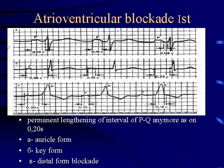 Atrioventricular blockade Іst • permanent lengthening of interval of P-Q anymore as on 0,