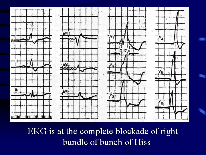 EKG is at the complete blockade of right bundle of bunch of Hiss 