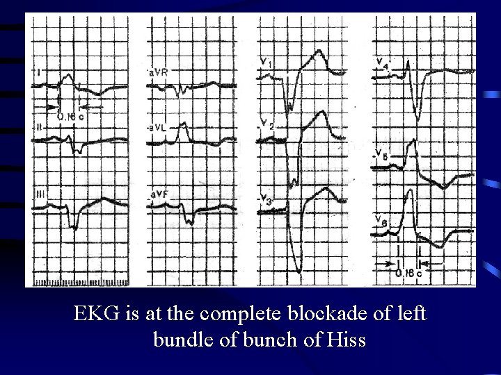 EKG is at the complete blockade of left bundle of bunch of Hiss 