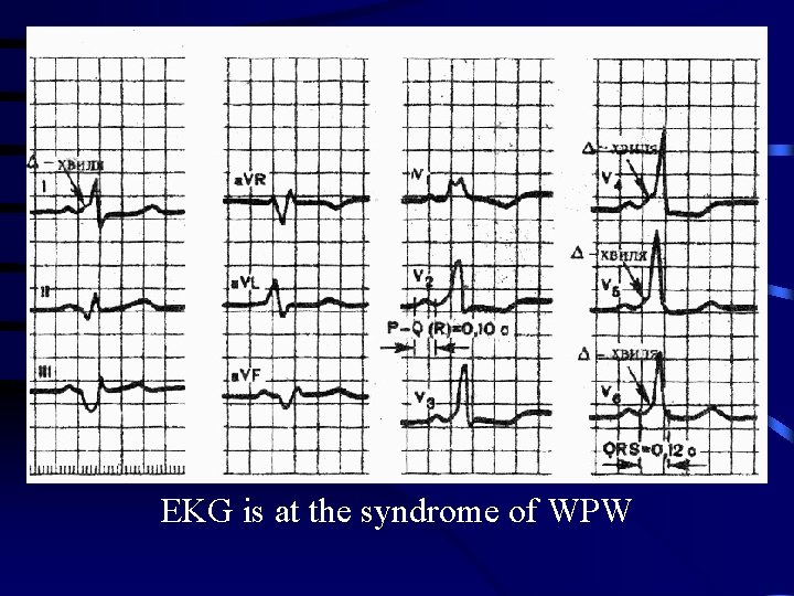 EKG is at the syndrome of WPW 