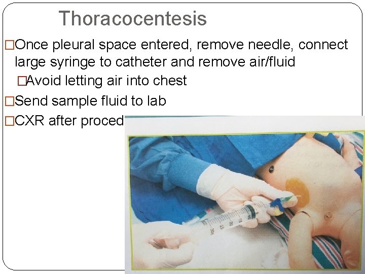 Thoracocentesis �Once pleural space entered, remove needle, connect large syringe to catheter and remove