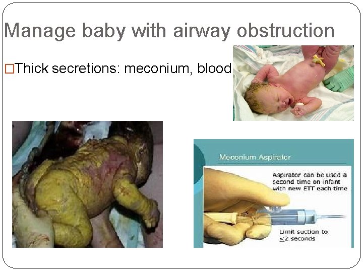Manage baby with airway obstruction �Thick secretions: meconium, blood 