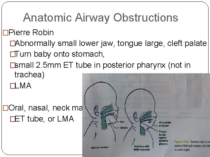 Anatomic Airway Obstructions �Pierre Robin �Abnormally small lower jaw, tongue large, cleft palate �Turn