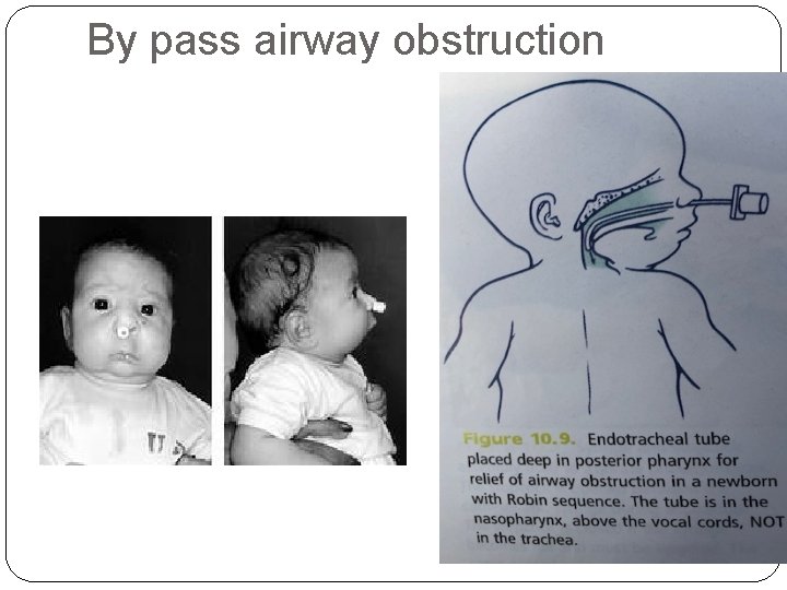 By pass airway obstruction 